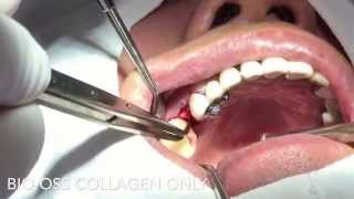 Ridge preservation  BioOss Collagen only No membrane coverage [upl. by Nidak]