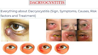 DACRYOCYSTITIS Sign Symptoms Causes Risk factors Treatment [upl. by Ydiarf]