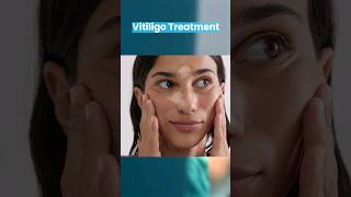 Vitiligo Treatment by Surgery  Dr Gaurav Garg Dermatologist [upl. by Hajidahk]