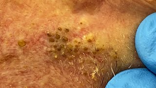 Extremely Clogged Pores Extracted  Contour Dermatology [upl. by Larimor]