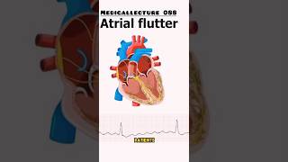 Attrial flutter  Arrhythmia  viral shorts heart [upl. by Chuu]