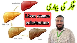 Coarse echotexture liver  chronic liver disease  hepatitis fatty liver [upl. by Harned]