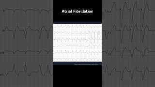 Atrial Fibrillation with left bundle branch block LBBB [upl. by Anikas]