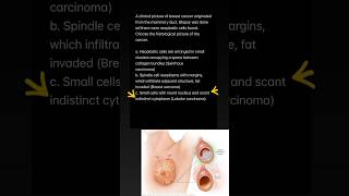 PLAB MCQS HINDI URDU Lobular Carcinoma exam medico plab1 mbbs anatomy neetpgexam neetpg [upl. by Schlenger]