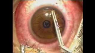 Lasik Laser Eye Surgery Procedure  Live Surgery [upl. by Crista]