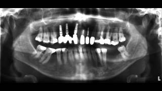 für Zahnärzte das OPTG Röntgen [upl. by Zigmund]