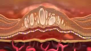 Lucentis and Macular Degeneration [upl. by Enuahs298]