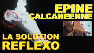 EPINE DU TALON CALCANEENNE DE LENOIR ESSAYEZ LA REFLEXOLOGIE PLANTAIRE LA SOLUTION NATURELLE [upl. by Anav958]