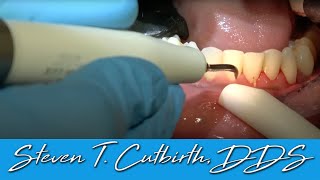 Scaling amp Root Planing  Dental Minute with Steven T Cutbirth DDS [upl. by Fryd653]