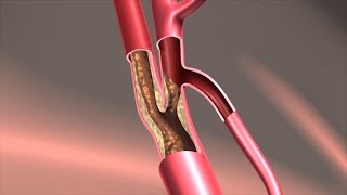 Endarterectomy Treatment [upl. by Duthie]