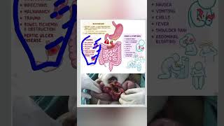 Intestinal perforation  Perforation in intestine [upl. by Nyvlem]