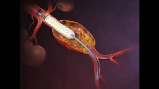 Tratamiento endovascular del Aneurisma de Aorta Abdominal [upl. by Etnelav829]