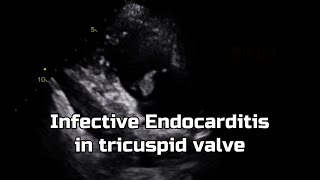 Infective Endocarditis in tricuspid valve [upl. by Eveiveneg]