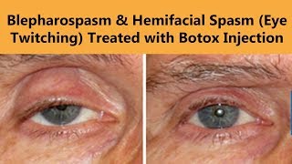 Botox Injection for Blepharospasm amp Hemifacial Spasm Eyelid Twitching  The Esthetic Clinics [upl. by Maxi475]