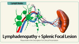 Lymphadenopathy and Splenic Focal Lesion [upl. by Ailesor872]