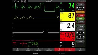 Ventricular Fibrillation with Defibrillation [upl. by Asaret655]