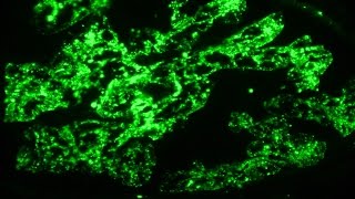 Nephritic syndrome and post infectious glomerulonephritis  Pathology mini tutorial [upl. by Alledi]