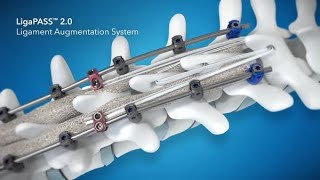 Promotional Video  LigaPASS ™ 20 Ligament Augmentation SoME System [upl. by Ennayllek377]