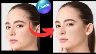 ACNE REMOVAL  Acne Treatment 040 [upl. by Camile]