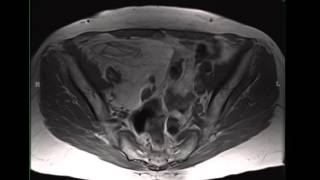 Retroperitoneal liposarcoma [upl. by Ezequiel275]