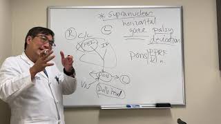 Gaze deviation in stroke vs seizure [upl. by Obellia]