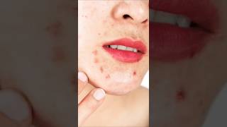 How to reduce Hormonal acne dermatologist doctor skincareforwomen acne acnetreatment face [upl. by Nongim]