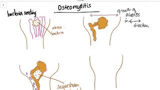 Osteomyelitis  Sequestrum Involucrum Draining sinus Explained [upl. by Madaih60]