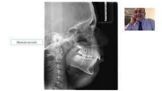 Landmarks on Lateral Cephalogram [upl. by Noemad704]