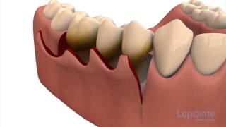 Periodontal flap approach surgery  Lapointe dental centres [upl. by Chaves]