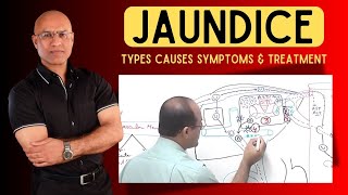 Jaundice  Types Causes Symptoms and Treatment [upl. by Sauncho]