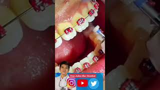 ENAMELOPLASTY Lagaring Ngipin paano inaayos [upl. by Asiul]