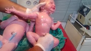 New born baby twins both are female cleaning process remove vernix both baby is strong cry is🥰🖤 [upl. by Yenaffit211]