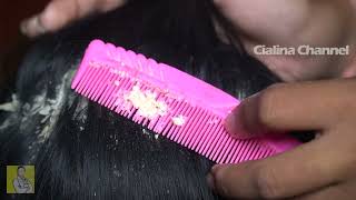 Satisfying Extremely Damaged Dandruff Scratching 2000 [upl. by Jarus623]