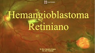 Hemangioblastoma Retiniano Tratamiento [upl. by Murrah]