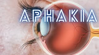 Aphakia  Ophthalmology Lecture [upl. by Cati]