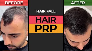 Hair PRP Results  Patient Journey  HASH CLINICS [upl. by Yecak583]