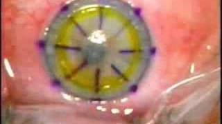 Lamellar Keratoplasty LK [upl. by Feetal]