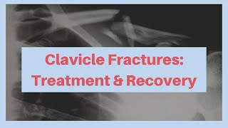 What is the treatment and recovery from a clavicle fracture [upl. by Medrek920]