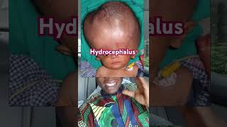 A baby with hydrocephalus shorts [upl. by Sedlik]