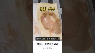 진물이 너무 많아요 대퇴부 골반 욕창 감염 소독 치료 드레싱 병원 항생제 bedsore pressure sore surgery infection seoul korea아문TV [upl. by Acirat]