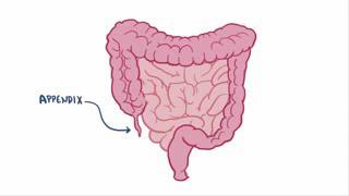 Vermiform appendix by Dr Dileep shah [upl. by Anitsyrc]