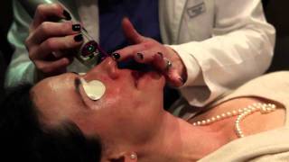 Laser treatment for Rosacea Birmingham Alabama  Cosmetic Dermatology [upl. by Eniamirt]