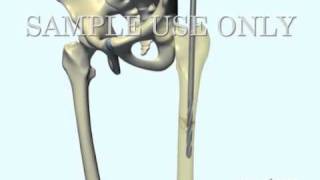 Femoral Fracture Fixation Surgery Intramedullary Nail [upl. by Annahaj435]