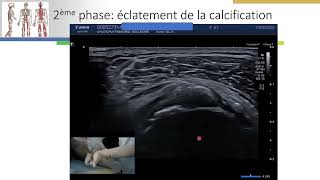 Calcification dépaule ponction lavage sous guidage échographique 2ème vidéo [upl. by Agem694]