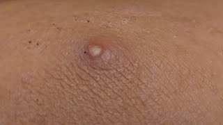 Drainage of an infected cyst on the leg [upl. by Packton]