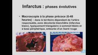 Ischémie Infractus Partie 2 [upl. by Dahc]