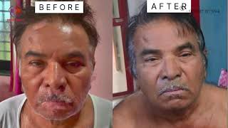 Amazing 2Month Vitiligo Treatment Results  vitiligotreatment  Dr Danials Clinic [upl. by Jenks]