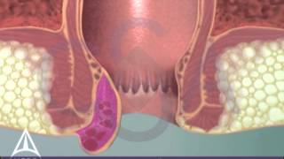 Thrombosed External Hemorrhoid  3D Medical Animation [upl. by Cherlyn]