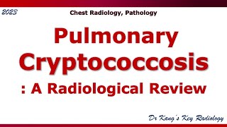 Pulmonary Cryptococcosis Radiologic Findings [upl. by Namzzaj614]