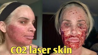 7Day Journey My CO2 Laser Skin Resurfacing Experience – Before and after chris link [upl. by Eibrab806]